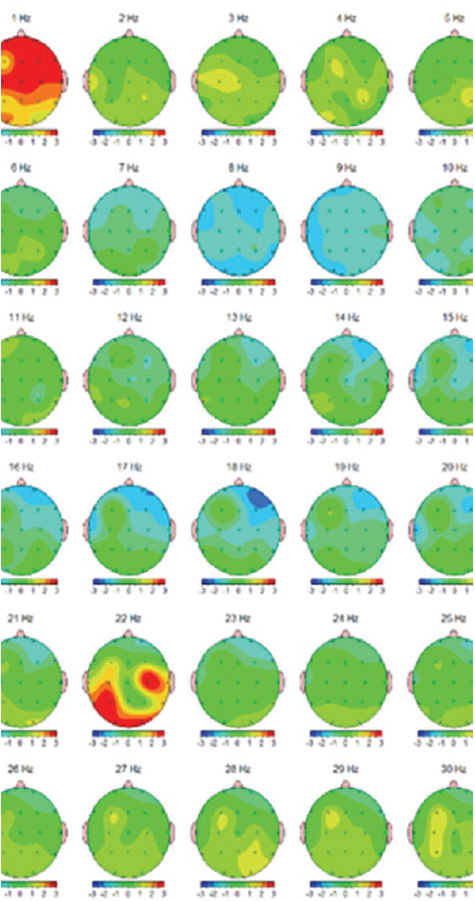 Scansione cervello dopo della sessione Bars Scansione cervello dopo della sessione Bars
