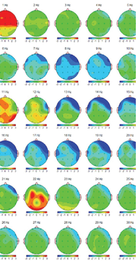 Scansione cervello prima della sessione Bars Scansione cervello prima della sessione Bars